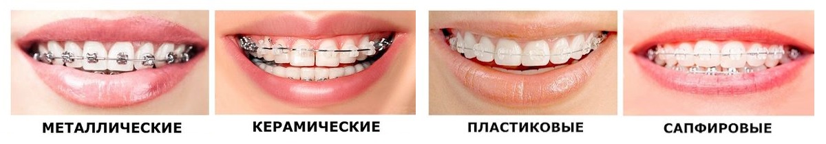Ортодонтическое лечение взрослых и детей №23